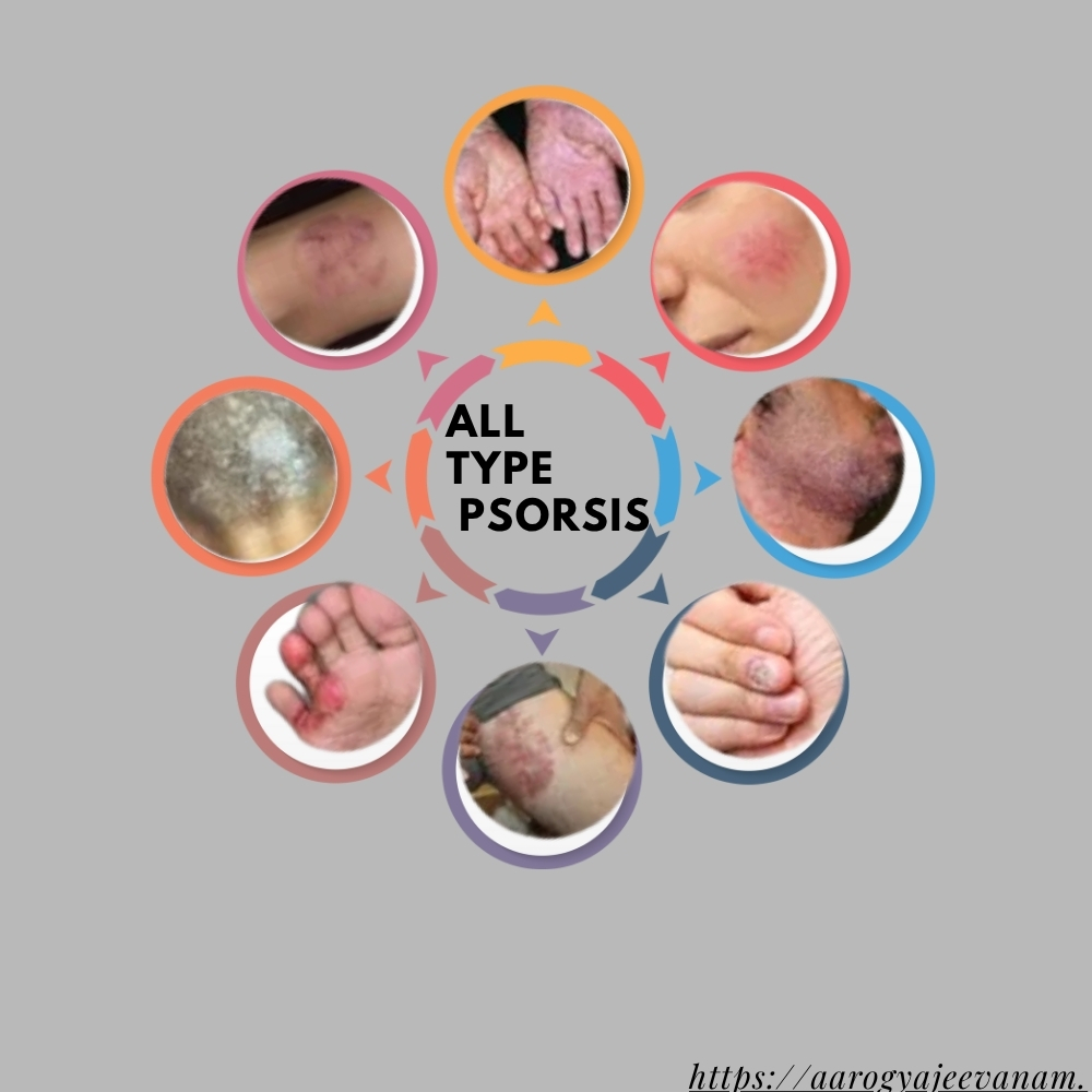 Phyrosis Skin Care Herbal Syrup (200ml)